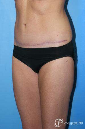 Denver Tummy Tuck - Abdominoplasty 7713 - After Image 2