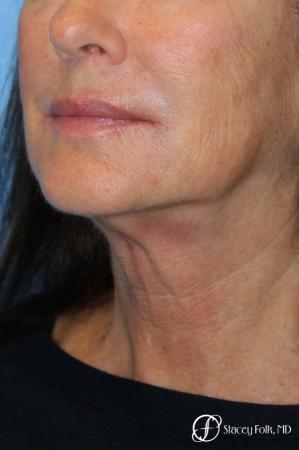 Denver Facelift & Laser Resurfacing 8277 - Before Image 2