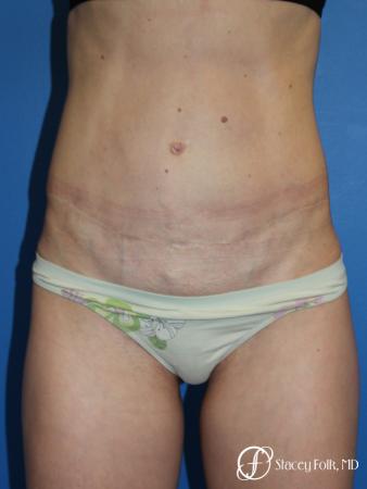 Denver Tummy Tuck (Abdominoplasty) 11239 - After Image 1