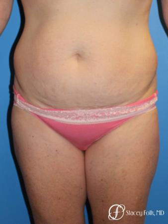 Denver Tummy Tuck 4817 - Before Image 1