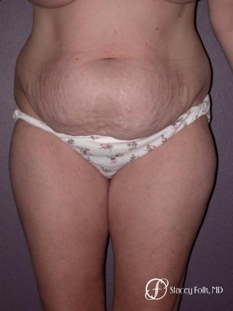 Denver Tummy Tuck 18 - Before