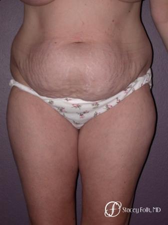 Denver Tummy Tuck 18 - Before Image 1