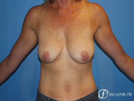 Breast Augmentation with Breast Lift (Augmentation/Mastopexy) - Before Image 1