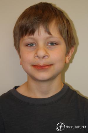 Denver Cleft Lip and Palate Repair 963 - After 1