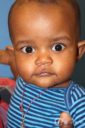 Denver Cleft lip repair 5934 - After Image 1
