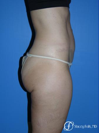 Denver Tummy Tuck Abdominoplasty 5485 - After Image 2
