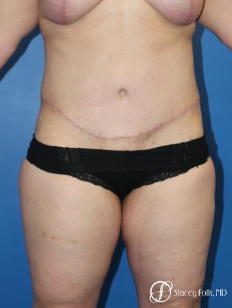 Tummy Tuck (Abdominoplasty) - After Image 1