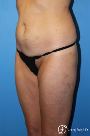 Denver Tummy Tuck - Abdominoplasty 7713 - Before Image 2