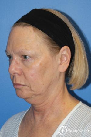 Facial Rejuvenation: Patient 1 - Before Image 2