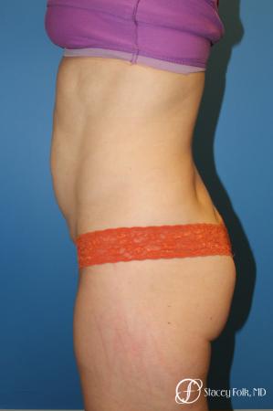 Denver Tummy Tuck - Abdominoplasty 8266 - Before and After Image 3