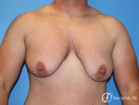 Denver FTM Female to male top surgery 5252 - Before Image 1