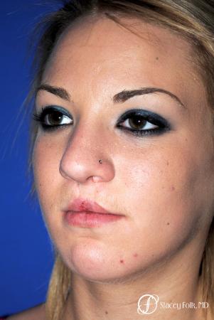 Denver Septorhinoplasty and Cleft Lip Repair 8162 - Before Image 2