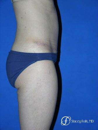 Denver Tummy Tuck 35 - After Image 3
