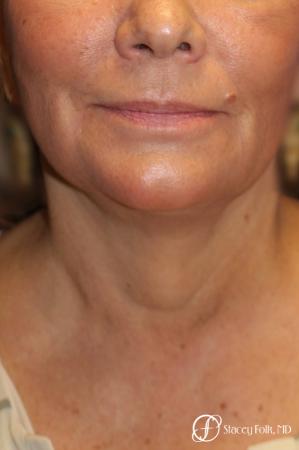 Denver Facial Rejuvenation Face Lift, Fat Injection, Laser Resurfacing 7123 - After Image 3