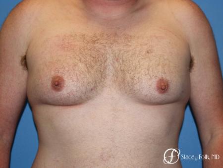 Denver FTM Female to Male Top Surgery 7109 - Before Image 1