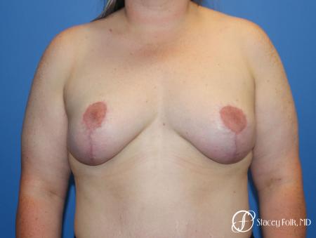 Breast Lift (Mastopexy) - After Image 1
