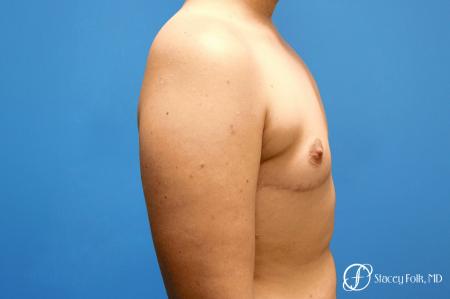 Denver FTM Top Surgery 5088 - After Image 3