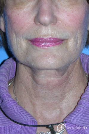 Denver Facial Rejuvenation Face Lift, Fat Injections, Laser Resurfacing 7116 - Before and After Image 3