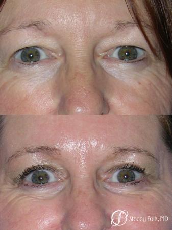 Denver Upper and Lower Lid Blepharoplasty 7159 - Before Image 1