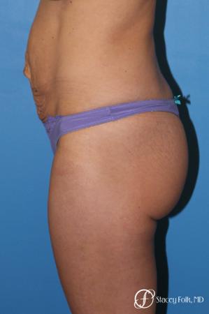 Denver Tummy Tuck - Abdominoplasty 8299 - Before and After Image 3