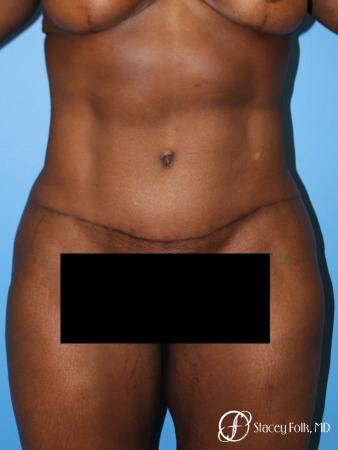 Denver Tummy Tuck - Abdominoplasty 7514 - After Image 1
