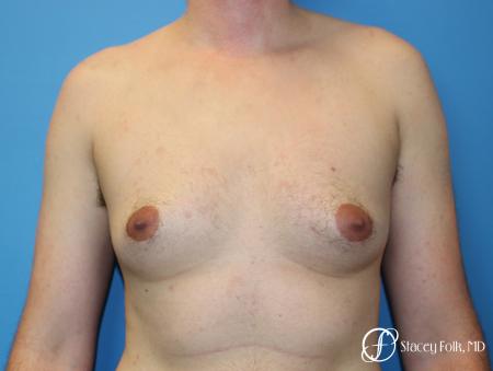 Denver FTM Female to Male Top Surgery 7708 - Before Image 1