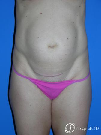 Denver Tummy Tuck 3528 - Before Image 1