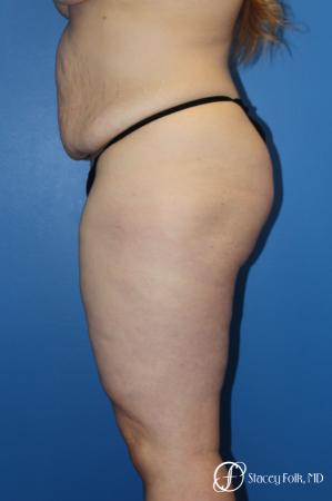 Tummy Tuck (Abdominoplasty) - Before and After Image 3