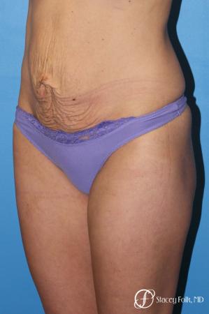 Denver Tummy Tuck - Abdominoplasty 8299 - Before Image 2