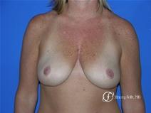 Denver Breast Reduction 14 - After Image 1