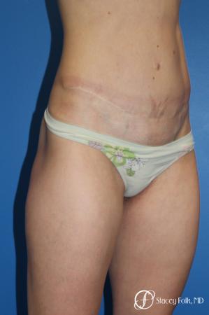 Denver Tummy Tuck (Abdominoplasty) 11239 - After Image 4