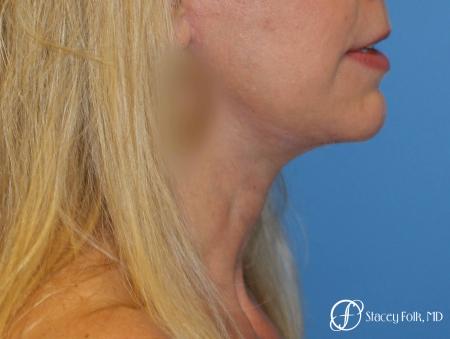 Denver Facial Rejuvenation Face Lift and Fat Injections 7126 - After Image 1