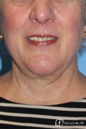Denver Facial Rejuvenation Face and Neck Lift with Fat Transfer to the Face 9133 - After Image 2