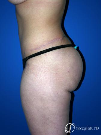 Denver Tummy Tuck 23 - After Image 2
