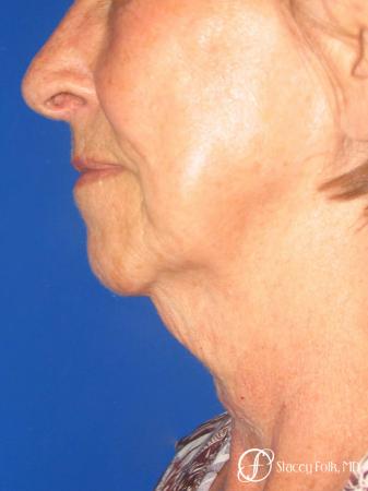 Denver Facial Rejuvenation Face Lift and Fat Injections 7129 - Before Image 1