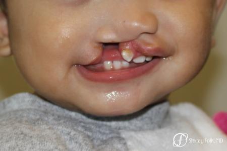 Denver Cleft Lip and Palate Repair 10315 - Before Image 1