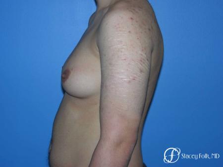 Denver FTM Female to male top surgery 5105 - Before and After Image 3