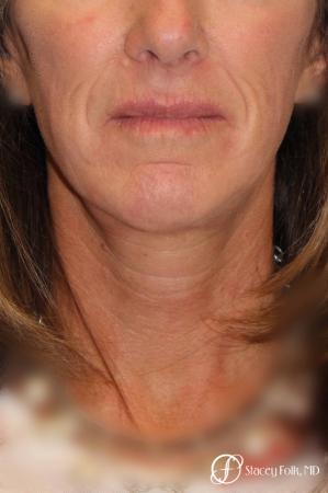 Denver Facial Rejuvenation Face lift, Fat Injections, and Laser Resurfacing 7132 - After Image 3