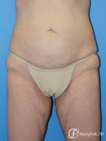Denver Body Lift Belt lipectomy 5268 - Before Image 1