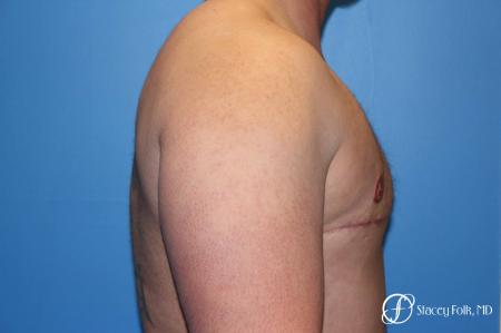 Denver FTM Female to male top surgery 5252 - After Image 3