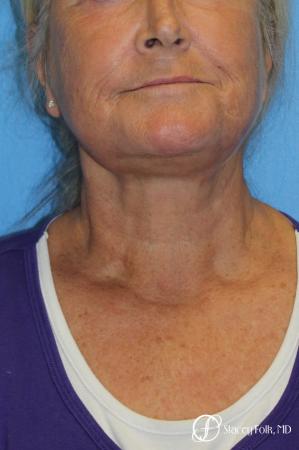 Facelift and Laser - After Image 2