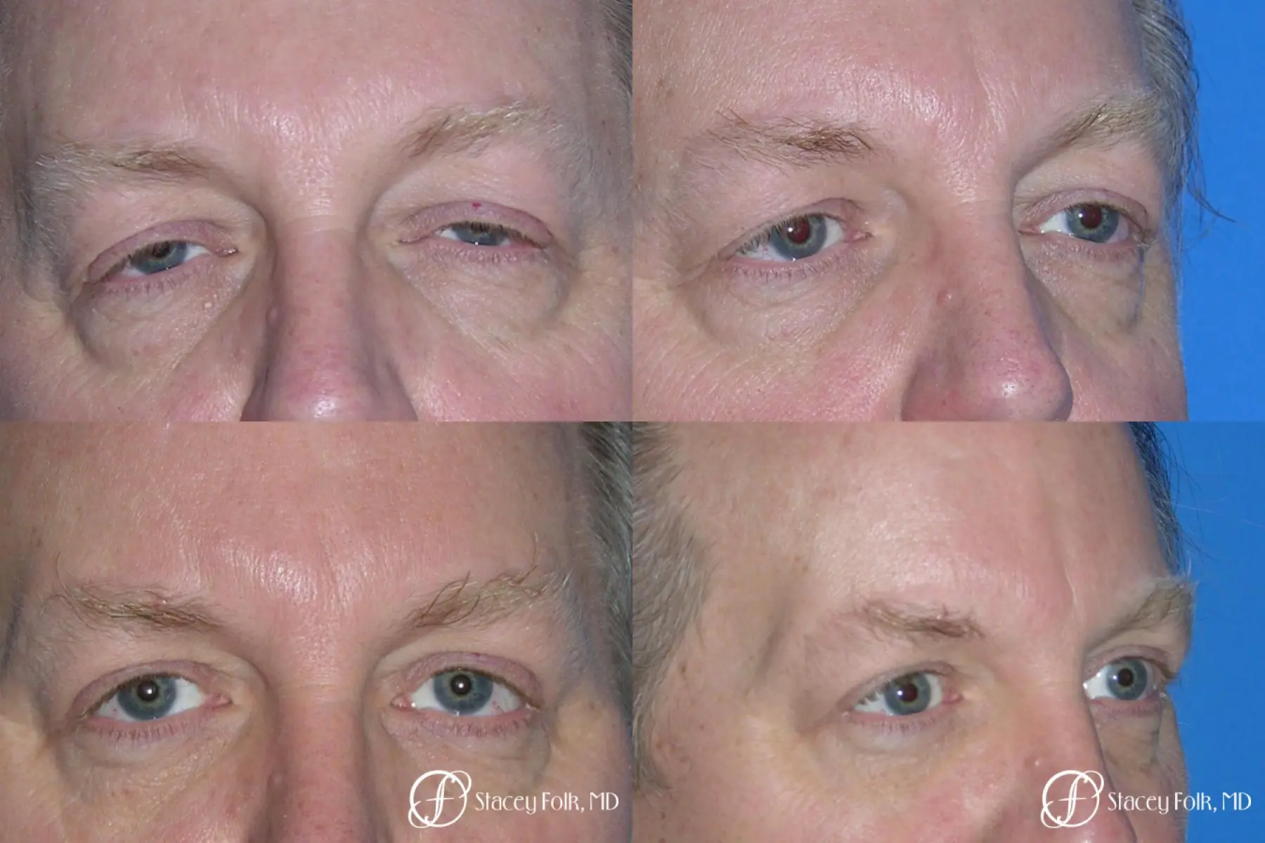 Denver Upper & Lower Blepharoplasty 7158 - Before and After