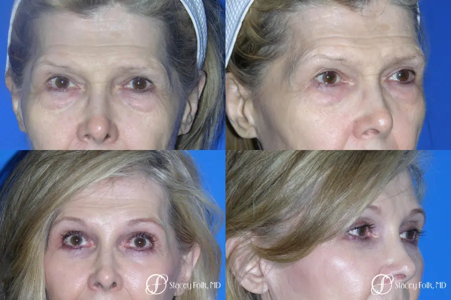 Denver Brow Lift and Upper Blepharoplasty 7161 - Before and After