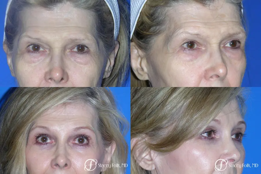 Denver Brow Lift and Upper Blepharoplasty 7161 - Before and After 1