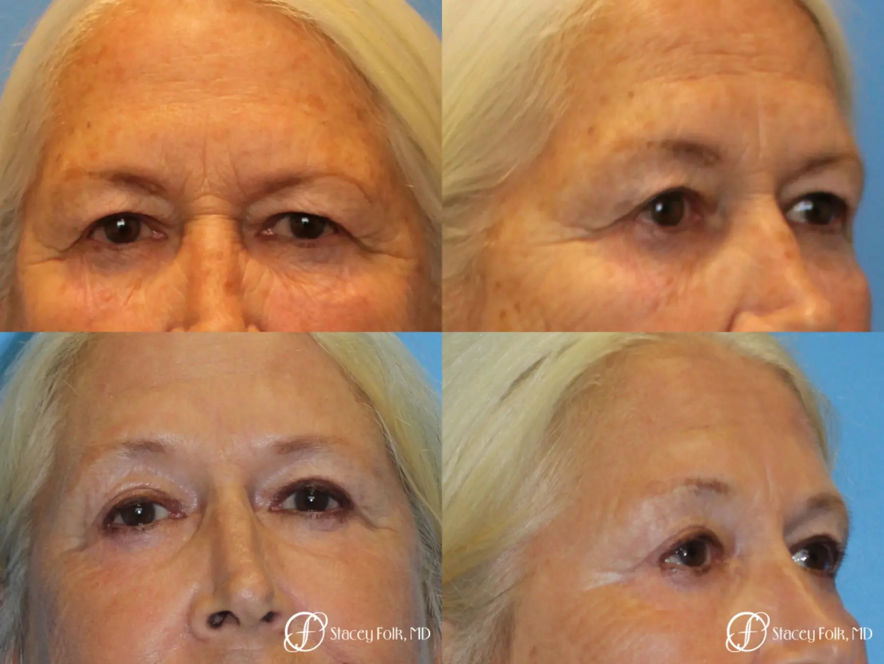 Upper Lid Blepharoplasty - Before and After