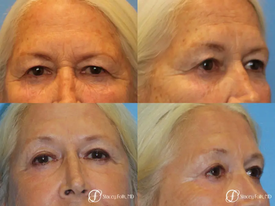 Upper Lid Blepharoplasty - Before and After 1