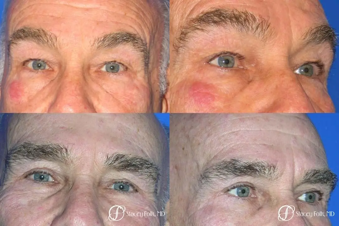 Denver Blepharoplasty 8273 - Before and After