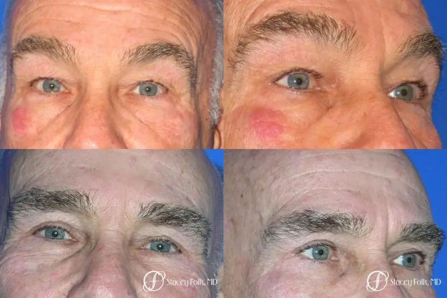 Denver Blepharoplasty 8273 - Before and After 1