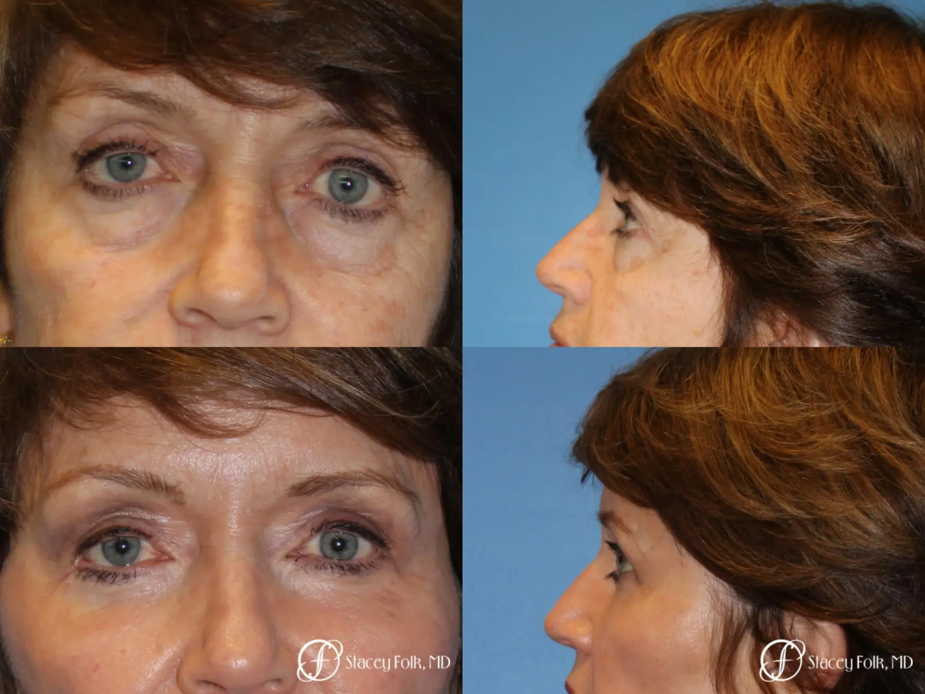 Denver Lower Lid Blepharoplasty 8640 - Before and After