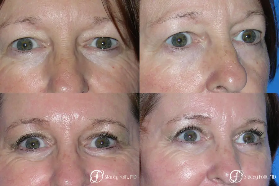 Denver Upper and Lower Lid Blepharoplasty 7159 - Before and After 1